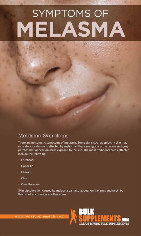 Melasma: Symptoms, Causes & Treatment