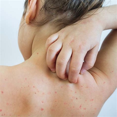 Does Chickenpox Still Exist 2024 - Elly Noelle