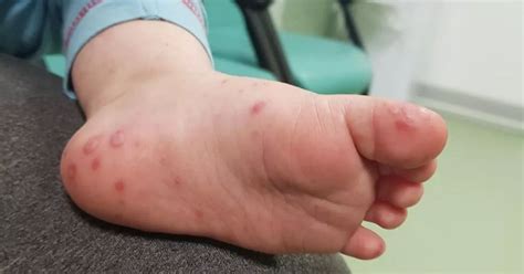 Nurses share pictures of hand, foot and mouth disease after case in Rochdale - Manchester ...