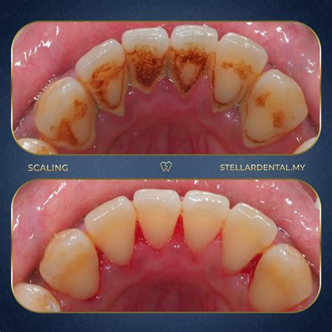 Teeth Scaling: Teeth Cleaning Treatment - Stellar Dental