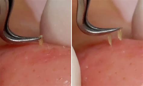 Pulling Out Sebum Plugs With Tweezers | Is It Safe? - Blushastic