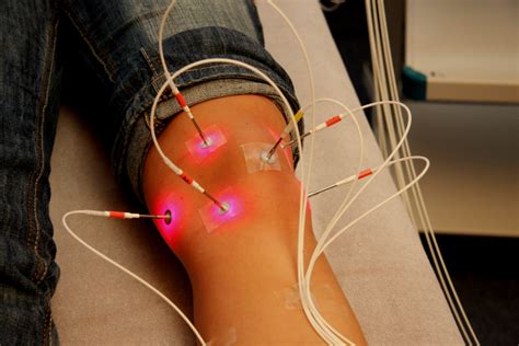 Laserneedle Acupuncture | International Society for Medical Laser Applications