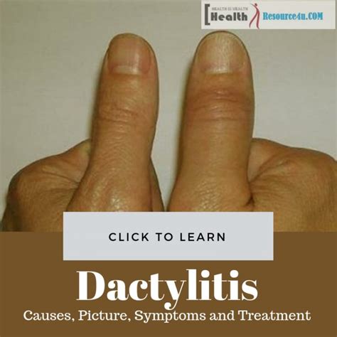 Dactylitis: Causes, Picture, Symptoms And Treatment