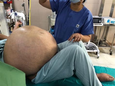 Doctors in India remove 'world's largest ovarian tumour' from woman | Metro News