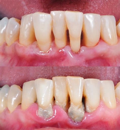 Gum Disease: Symptoms, Prevention, and Treatment - Cosmetic Dentist ...