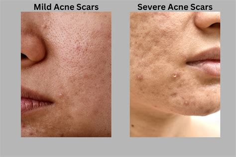 Erase Acne Scars With PRP Microneedling — TaVieMD MedSpa