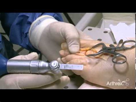 Surgical technique by Dr Belis: Plantar Plate Repair on Cadaver June 2013 - YouTube