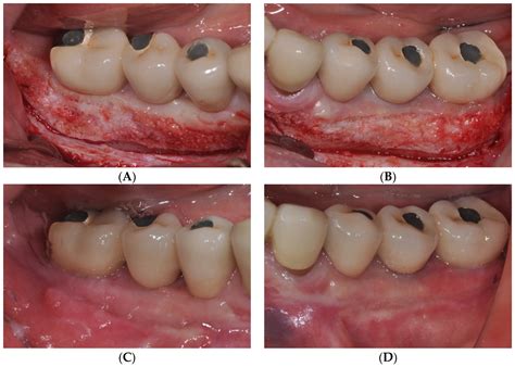 Medicina | Free Full-Text | Technical Note on Vestibuloplasty around Dental Implants Using ...