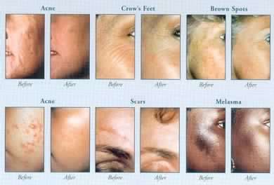 DIAMOND MICRODERMABRASION — Estevan Laser Health Clinic