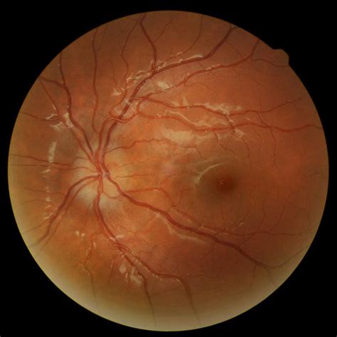 why do optic nerves look swollen – Los Alamos Family Eyecare, P.C.