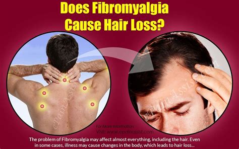 Does Fibromyalgia Cause Hair Loss? | Fibromyalgia causes, Fibromyalgia ...