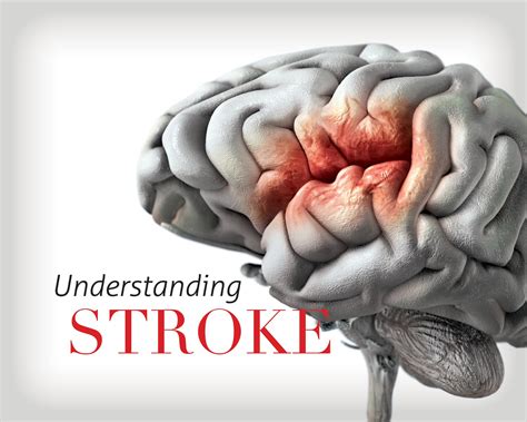 Traumagency: BRAINSTEM Stroke Syndromes