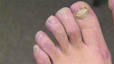 best medicine to get rid of toenail fungus - Toenail Fungus Treatment | Toenail Fungus Treatment