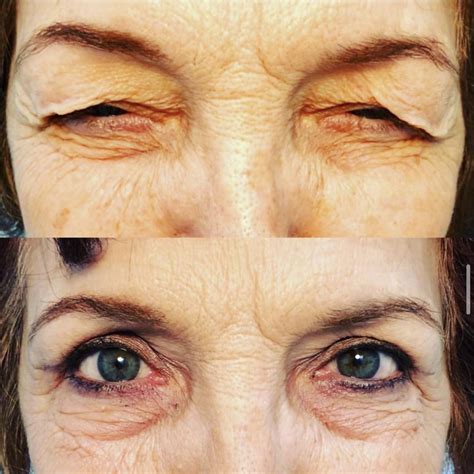 Patient 55495854 | Blepharoplasty (Eyelid Surgery) Before & After Photos | Soroudi Vision