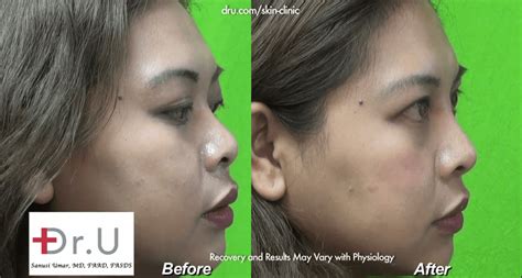 VIDEO: Nose Job Without Plastic Surgery | Low Nose Bridge Injection Results