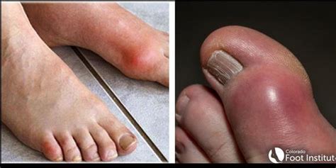 Gout-More than just a painful Red Toe