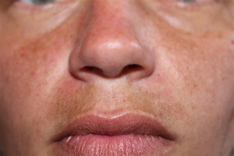 Melasma Mustache: How to Reverse Dark Upper Lip - Este