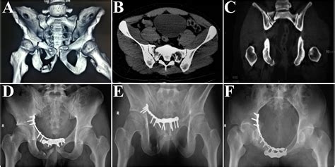 Feasibility of anterior pelvic ring fixation alone for treating lateral compression type 1 ...