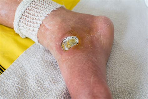 Diabetic Foot Ulcers – ResearchTrials.org