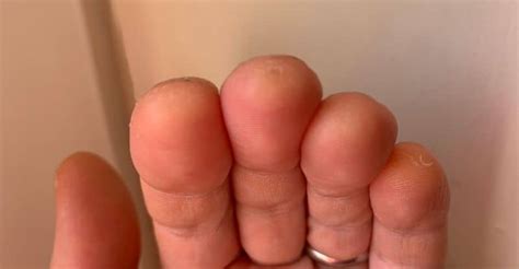 Guitar Calluses - What They Are & How to Build Them