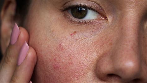 Can Over Exfoliating Cause Acne - Facial Adviser