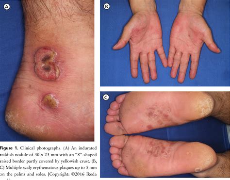 Figure 1 from Condylomata lata on the ankle: an unusual location ...