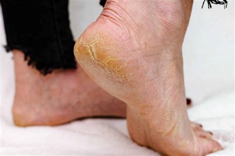 How to Remove Dry Skin on Feet | Doncaster Foot Clinic