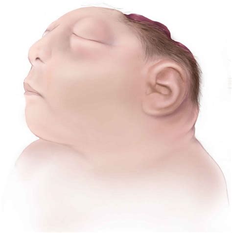 Anencephaly causes, symptoms, diagnosis, prognosis & anencephaly treatment