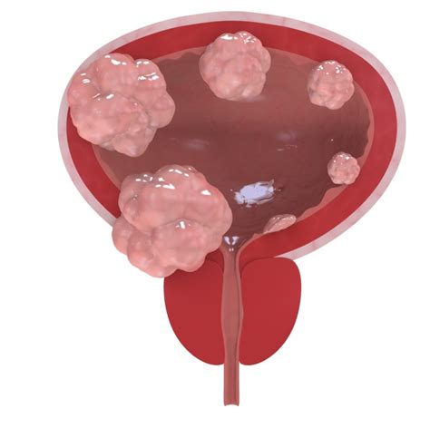 Enhanced Cystoscopy for Early Bladder Cancer - PeopleBeatingCancer