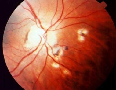 Ocular Toxoplasmosis: Overview, Pathogenesis, Congenital Versus Acquired Ocular Toxoplasmosis