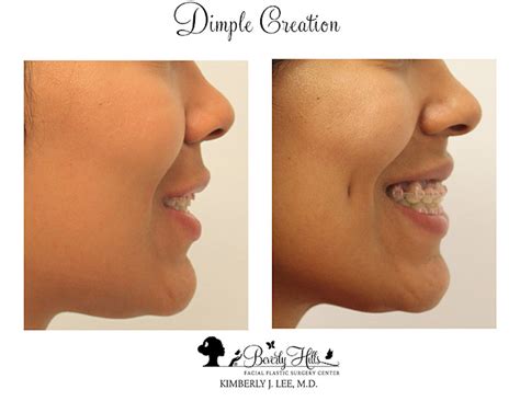 Dimple Creation Before & After Photos | Dr. Kimberly Lee