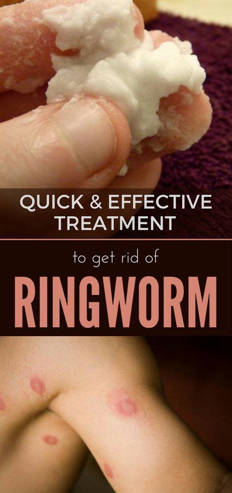 Quick and Effective Treatment to Get Rid of Ringworm | Home remedies for ringworm, Ringworm ...