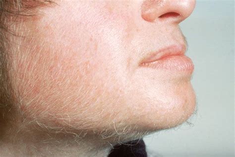 Vellus hairs are the short, fine, light colored hairs on the face and body. Description from ...