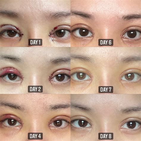 Collection 91+ Pictures Day By Day Eyelid Surgery Recovery Pictures Latest