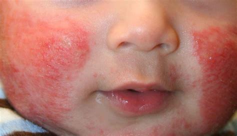Causes Of Skin Rashes