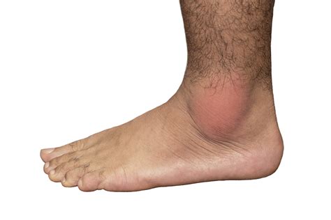 Can Gout Cause Ankle Swelling