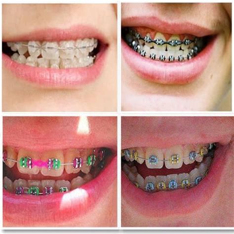 How to make homemade braces for halloween | gail's blog