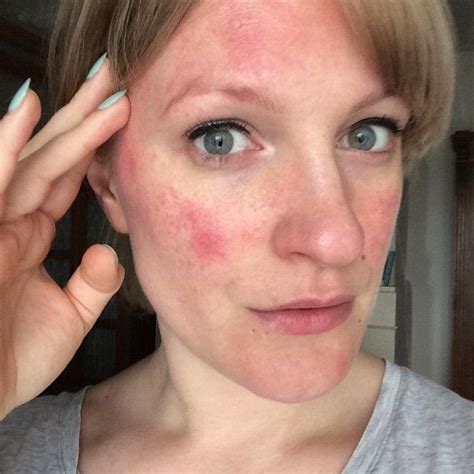 What It's Really like Living with Rosacea | Rosacea skin care, Rosacea acne treatment, Rosacea