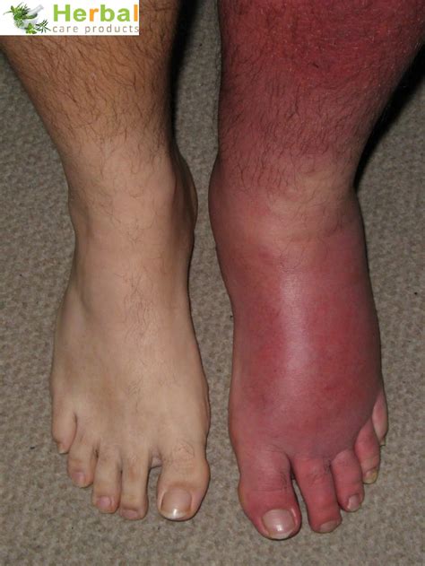 Cellulitis Pictures, Symptoms, Treatment & Complications