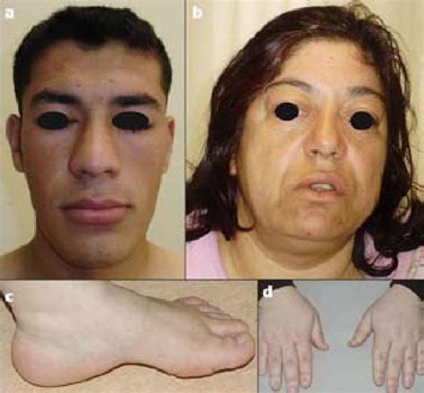 Acromegaly Progression