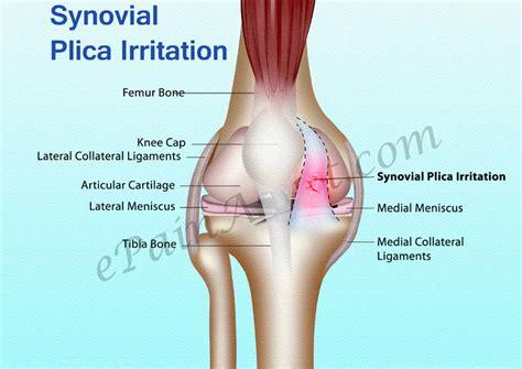 Synovial Plica | Etiology | Plica Snap | Leg presses | Knee Exercise | Leg