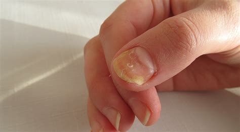 Show your fingernails some TLC. Protect them from fungal infection. - CHARMS Singapore