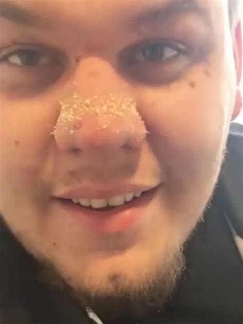 YouTuber has horrific solution for blackheads as he squeezes all of them at once - Daily Record