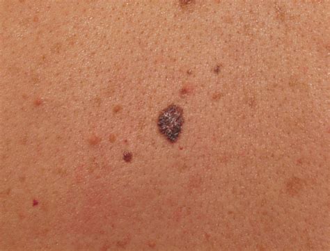 Early Stages Melanoma Skin Cancer Moles