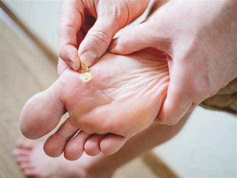 What to Expect With Plantar Warts Treatment: Bryon Butts, DPM: Podiatrist