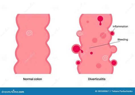 Diverticulitis and Diverticulosis Stock Vector - Illustration of human, anatomy: 285500067