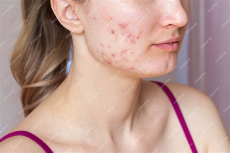 Premium Photo | Woman face the problem of acne