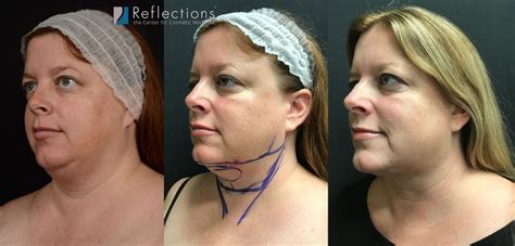 Laser Lipo Results for Double Chin on New Jersey Woman Before & After Photos New Jersey ...