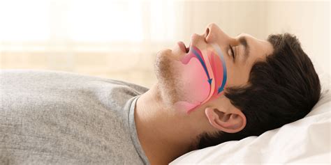 Sleep Apnea Treatment | Mohegan Lake & Tarrytown, New York