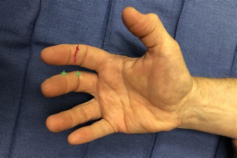 LACERATION (OPEN WOUND) | Hand Surgery Source